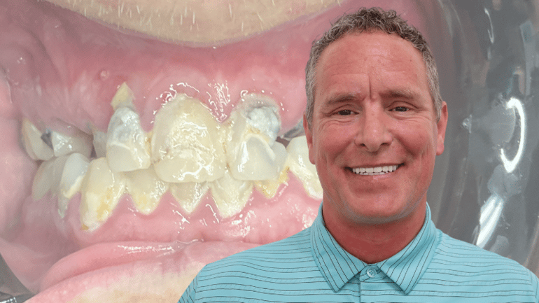 Dental Implants Salt Lake City