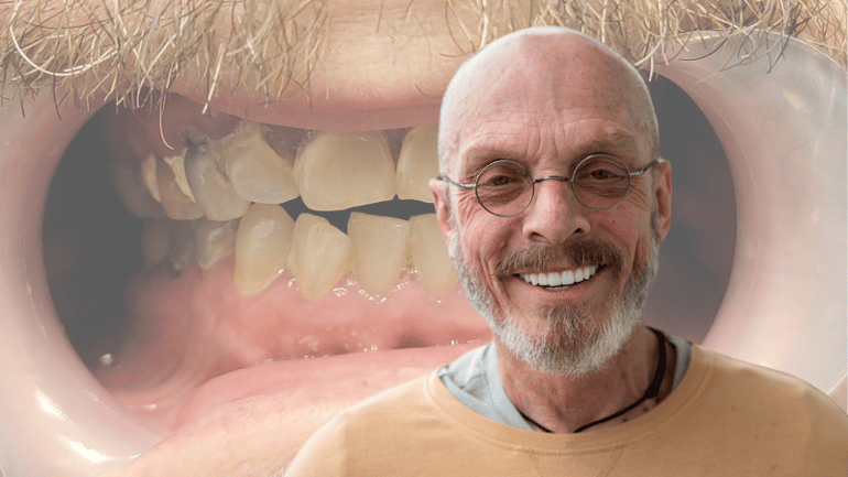 All-on-X Dental Implants Salt Lake City