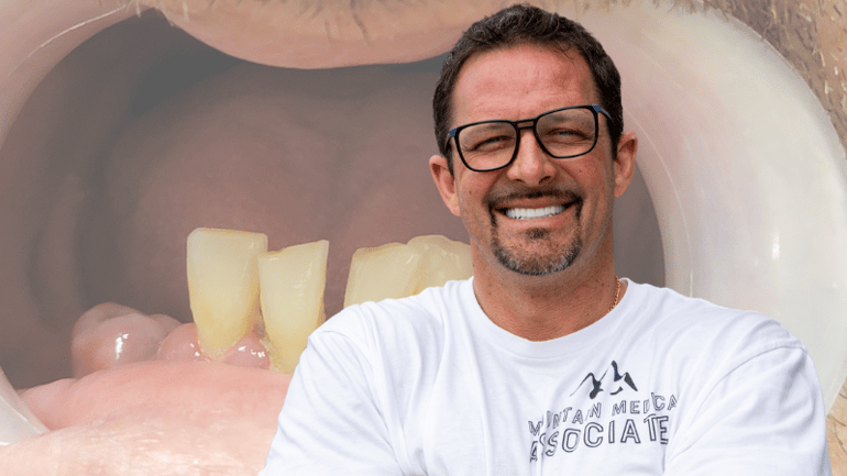 Before and after dental implants 