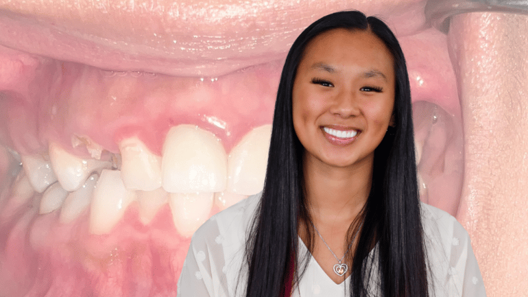 Stubbs Dental smile makeover review