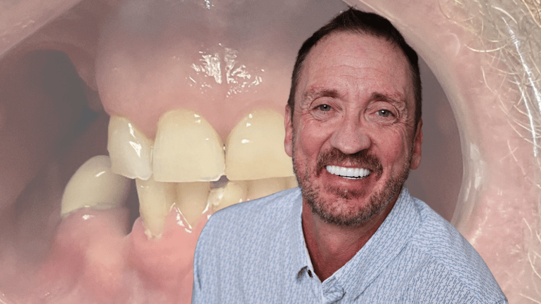 Stubbs Dental All-on-X Dental Implants