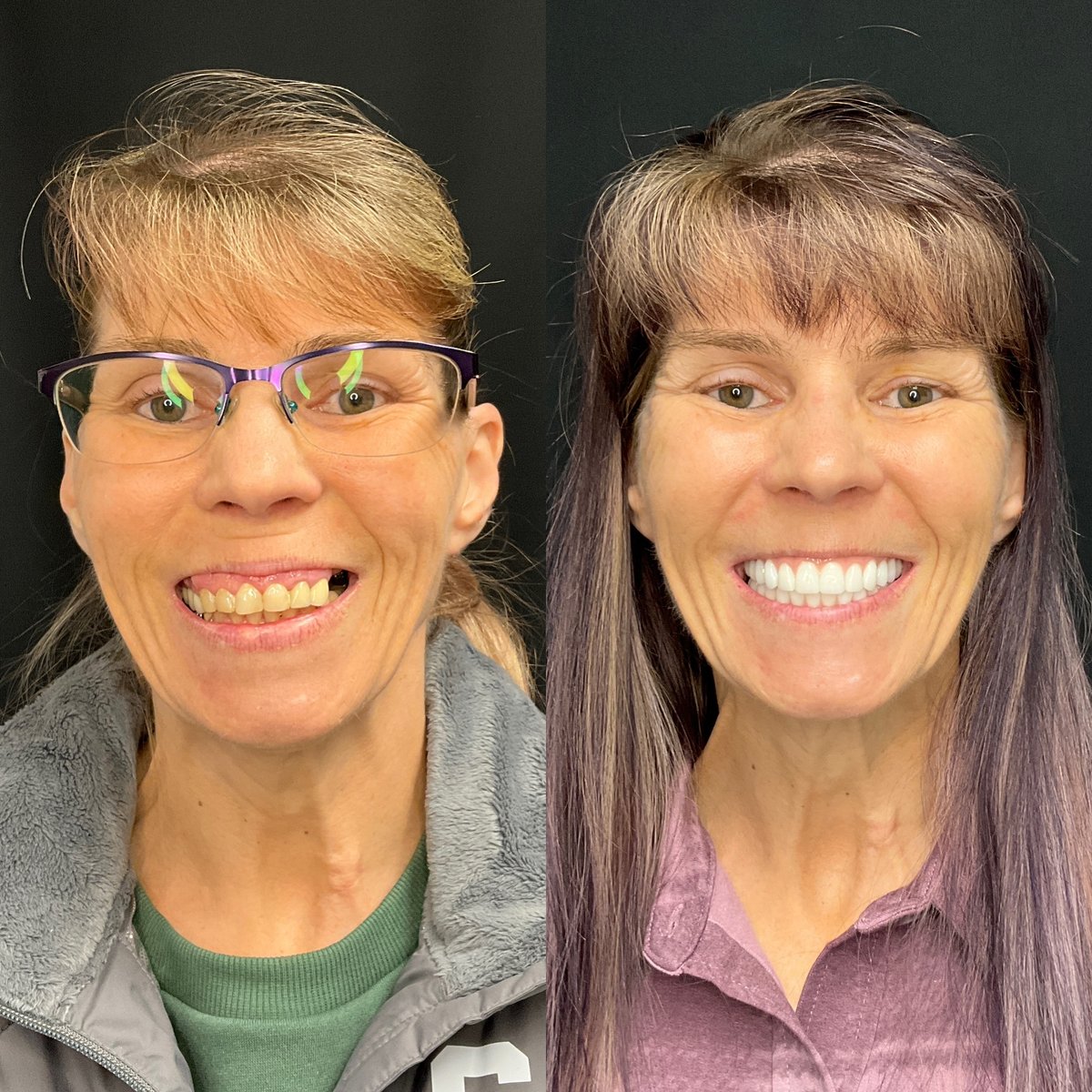 Before and after stubbs dental implant center