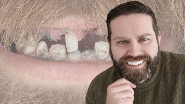 Dental Implants Utah Before and After