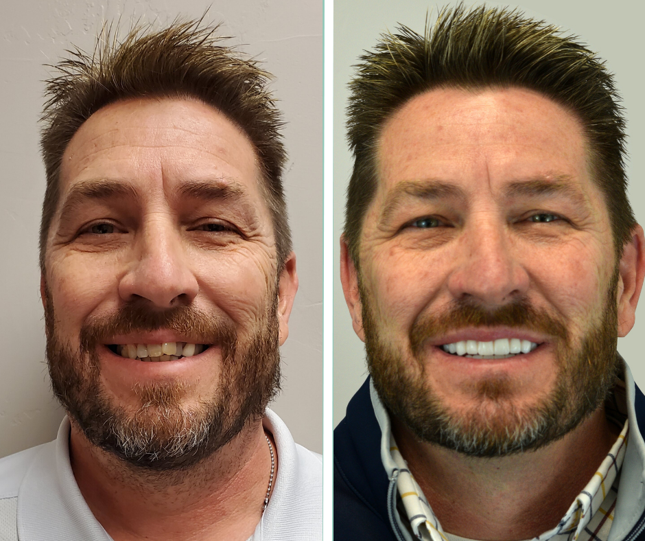 Before and after All-on-X dental implants