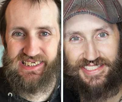 Before and after All-on-X dental implants