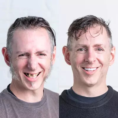 Before and After Dental Implants Stubbs Dental