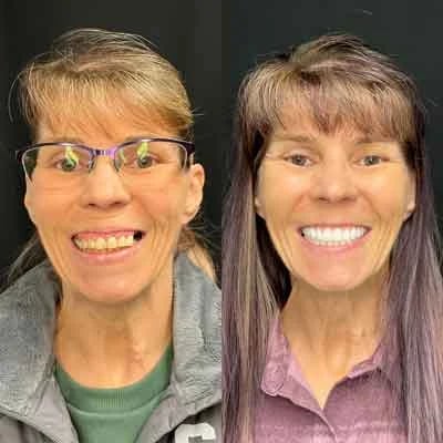 Before and After Dental Implants Stubbs Dental