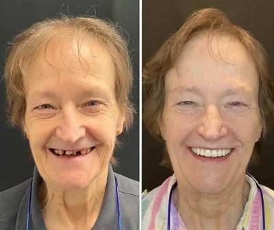 Before and after dental implants Stubbs Dental Implant Center