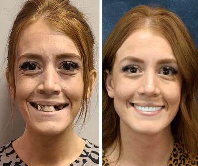 Before and after All-on-X dental implants